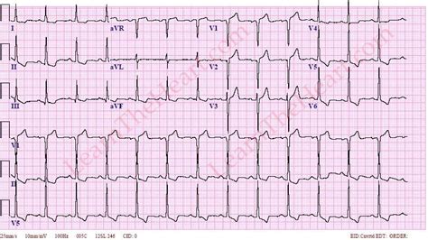 lvh strain pattern